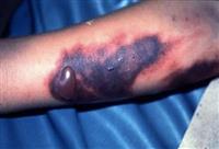 Căn bện nguy hiểm chết nhanh hơn HIV